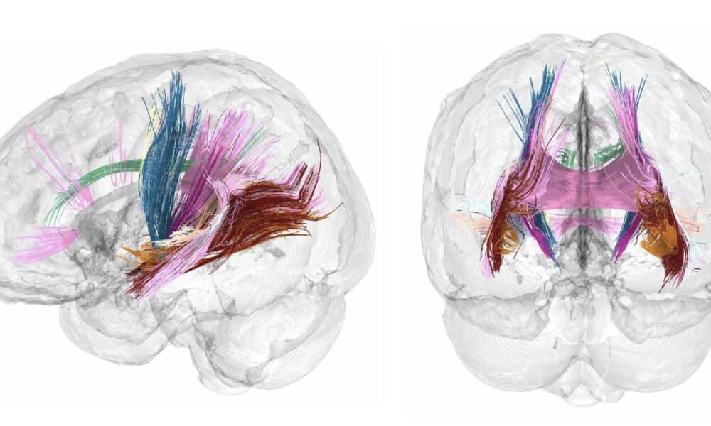 El volumen de materia gris cortical se reduce conforme avanza un embarazo. Los colores más oscuros indican las regiones que más reducen el volumen de materia gris durante la gestación.Crédito: Laura Pritschet