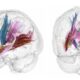 El volumen de materia gris cortical se reduce conforme avanza un embarazo. Los colores más oscuros indican las regiones que más reducen el volumen de materia gris durante la gestación.Crédito: Laura Pritschet