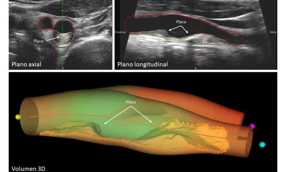 La imagen muestra un caso ejemplo de enfermedad ateroesclerótica que afecta a la arteria carótida. Las vistas axial (arriba a la izquierda) y longitudinal (arriba a la derecha) presentan una placa visible de gran tamaño y su extensión. La representación volumétrica en 3D (abajo) ofrece una visualización detallada y precisa de la placa, lo que permite una evaluación completa y exhaustiva de la enfermedad. Crédito. CNIC