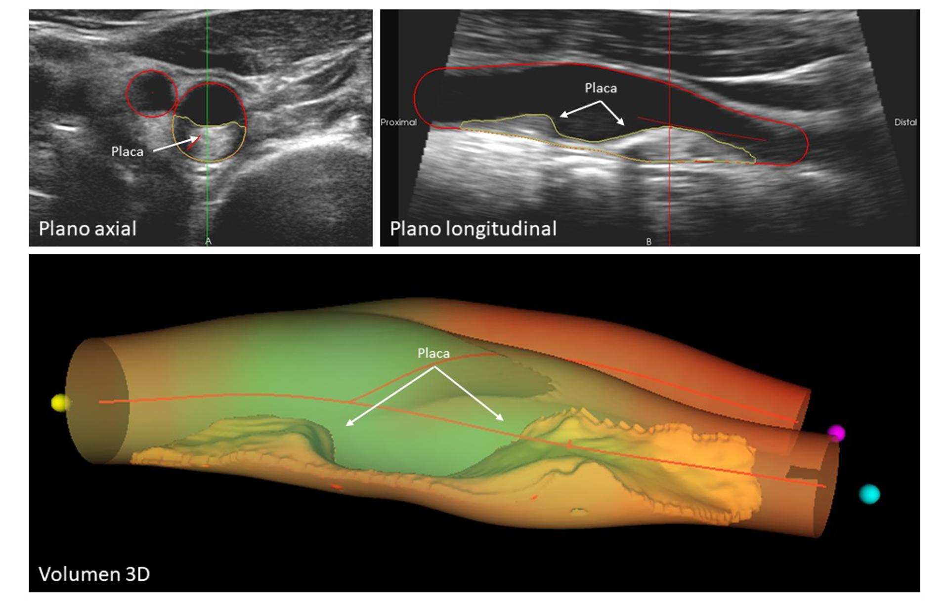La imagen muestra un caso ejemplo de enfermedad ateroesclerótica que afecta a la arteria carótida. Las vistas axial (arriba a la izquierda) y longitudinal (arriba a la derecha) presentan una placa visible de gran tamaño y su extensión. La representación volumétrica en 3D (abajo) ofrece una visualización detallada y precisa de la placa, lo que permite una evaluación completa y exhaustiva de la enfermedad. Crédito. CNIC