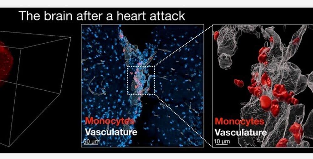 El corazón envía, después de sufrir un infarto, algunas señales al cerebro para desencadenar unos mayores deseos de dormir y acelerar así el proceso de recuperación, ya que ese descanso puede contribuir a reducir la inflamación.  Las imágenes de microscopía muestran el cerebro de un ratón tras un infarto. Fotografía facilitada por Mount Sinai Health System. EFE