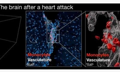 El corazón envía, después de sufrir un infarto, algunas señales al cerebro para desencadenar unos mayores deseos de dormir y acelerar así el proceso de recuperación, ya que ese descanso puede contribuir a reducir la inflamación.  Las imágenes de microscopía muestran el cerebro de un ratón tras un infarto. Fotografía facilitada por Mount Sinai Health System. EFE