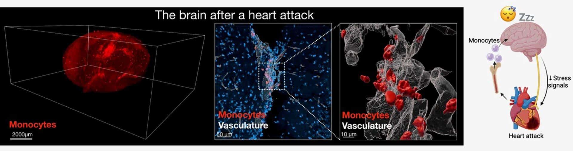 El corazón envía, después de sufrir un infarto, algunas señales al cerebro para desencadenar unos mayores deseos de dormir y acelerar así el proceso de recuperación, ya que ese descanso puede contribuir a reducir la inflamación.  Las imágenes de microscopía muestran el cerebro de un ratón tras un infarto. Fotografía facilitada por Mount Sinai Health System. EFE