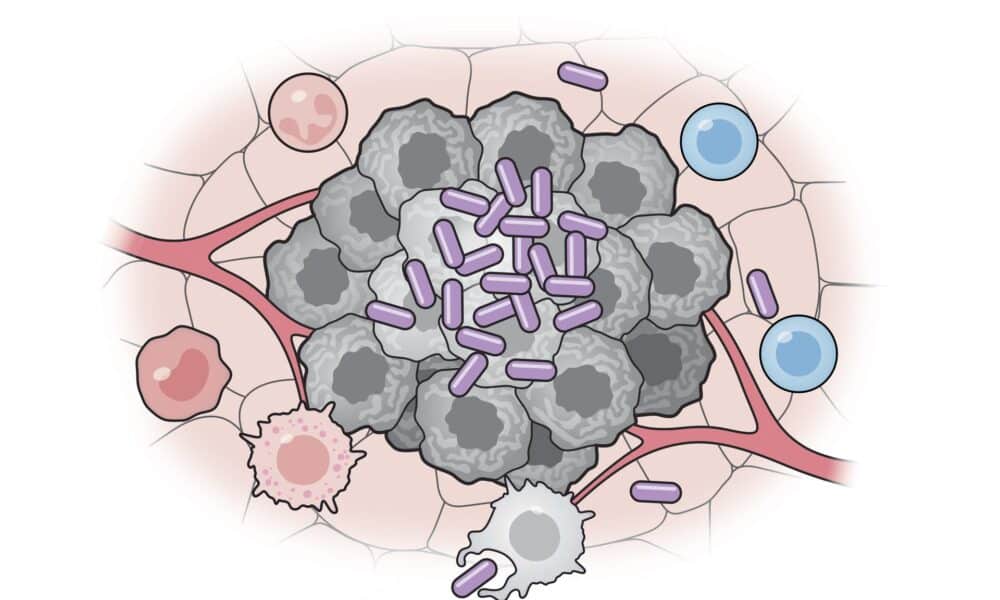 Células bacterianas artificiales (púrpura) activan varias partes del sistema inmunitario para atacar a las células tumorales (gris). Crédito: Universidad de Columbia