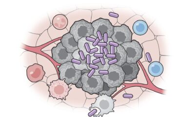 Células bacterianas artificiales (púrpura) activan varias partes del sistema inmunitario para atacar a las células tumorales (gris). Crédito: Universidad de Columbia