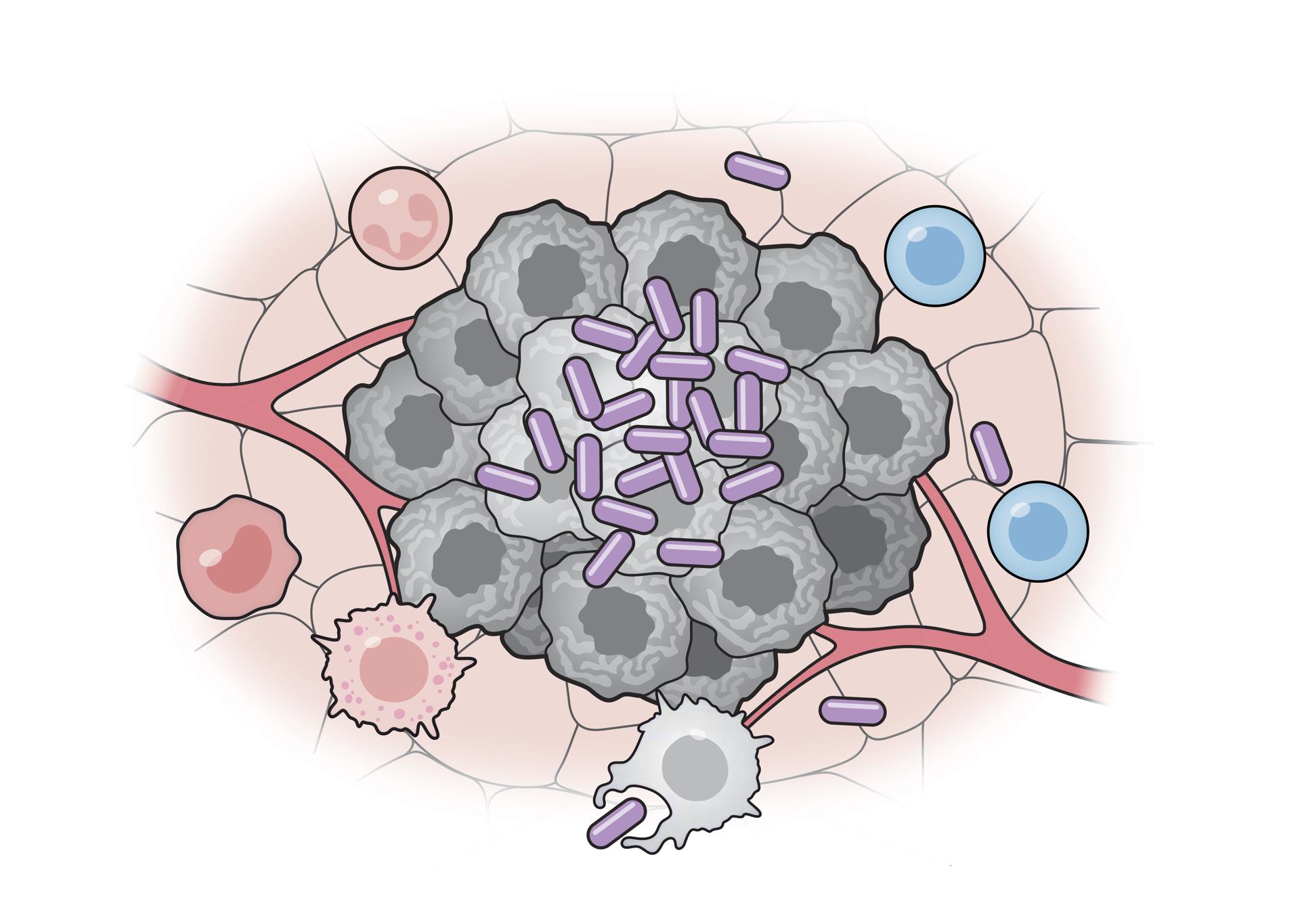 Células bacterianas artificiales (púrpura) activan varias partes del sistema inmunitario para atacar a las células tumorales (gris). Crédito: Universidad de Columbia