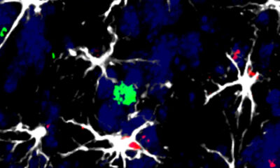 Células en torno a una metástasis cerebral en modelo animal: varias células cerebrales (astrocitos, blancas) rodean a una célula del sistema inmunitario (linfocito, verde). Algunos de ellos han empezado a activar el factor (rojo) inductor de la molécula TIMP1, que les permitirá inhabilitar la acción del linfocito contra las células tumorales. Crédito: CNIO.