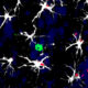 Células en torno a una metástasis cerebral en modelo animal: varias células cerebrales (astrocitos, blancas) rodean a una célula del sistema inmunitario (linfocito, verde). Algunos de ellos han empezado a activar el factor (rojo) inductor de la molécula TIMP1, que les permitirá inhabilitar la acción del linfocito contra las células tumorales. Crédito: CNIO.