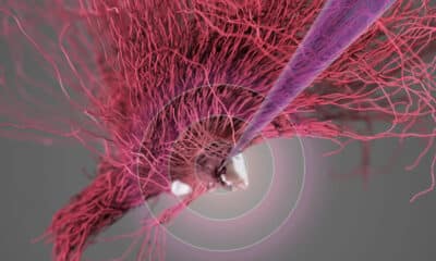 Representación visual de la estimulación cerebral profunda del hipotálamo lateral.Crédito: NeuroRestore/EPFL 2024.