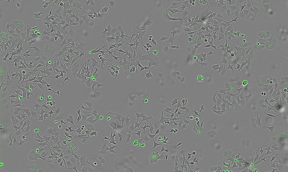 Un estudio internacional liderado por el Centro de Investigación del Cáncer (CIC) ha identificado un mecanismo por el cual una proteína secretada por la bacteria 'vibrio cholerae' es capaz de destruir células cancerosas. La imagen representa las células de cáncer muertas al activarse esa proteína. Imagen cedida por el CIC.