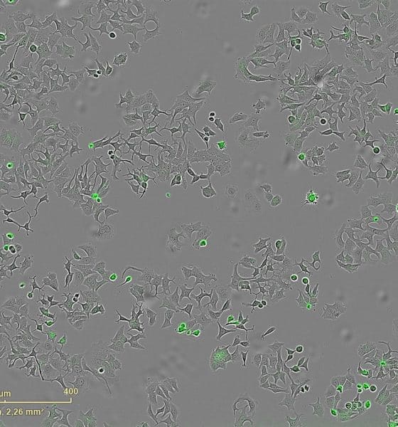 Un estudio internacional liderado por el Centro de Investigación del Cáncer (CIC) ha identificado un mecanismo por el cual una proteína secretada por la bacteria 'vibrio cholerae' es capaz de destruir células cancerosas. La imagen representa las células de cáncer muertas al activarse esa proteína. Imagen cedida por el CIC.