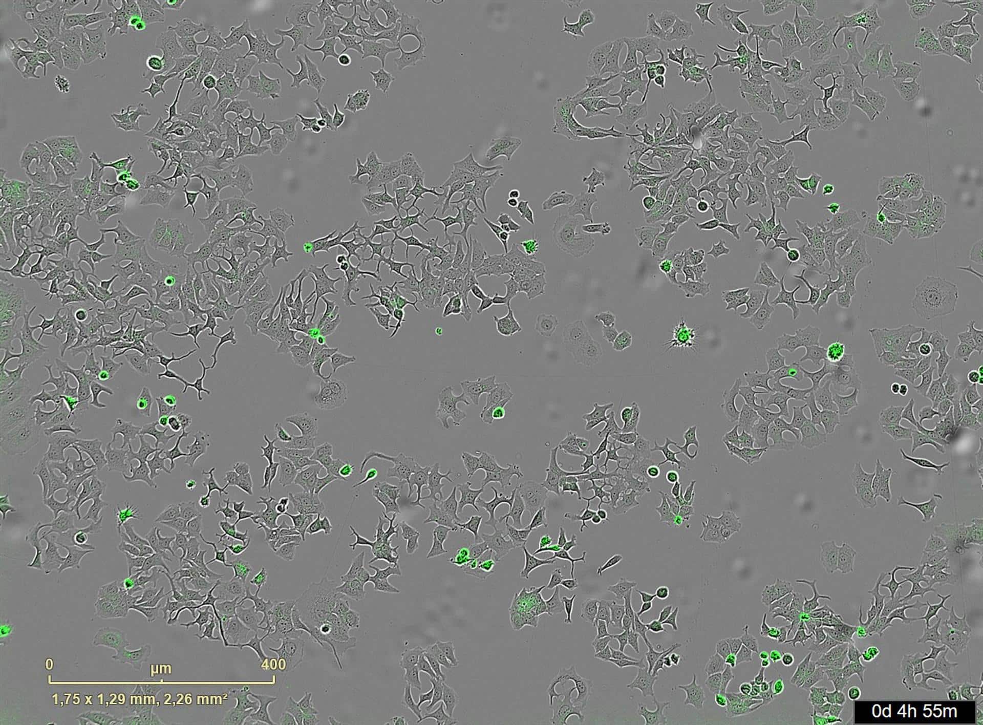Un estudio internacional liderado por el Centro de Investigación del Cáncer (CIC) ha identificado un mecanismo por el cual una proteína secretada por la bacteria 'vibrio cholerae' es capaz de destruir células cancerosas. La imagen representa las células de cáncer muertas al activarse esa proteína. Imagen cedida por el CIC.