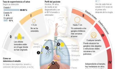 Infografía realizada por la agencia EFE basada en datos suministrados por el Grupo Español de Cáncer de Pulmón (GECP) y Roche Farma que muestra la clave en la detección temprana del cáncer de pulmón. EFE/ Miguel Mulas