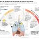 Infografía realizada por la agencia EFE basada en datos suministrados por el Grupo Español de Cáncer de Pulmón (GECP) y Roche Farma que muestra la clave en la detección temprana del cáncer de pulmón. EFE/ Miguel Mulas