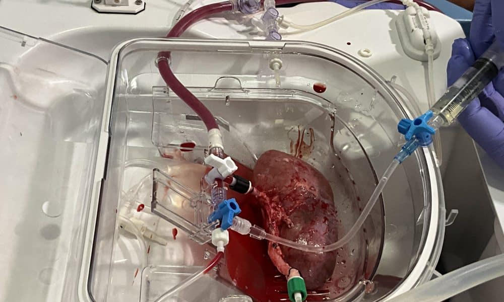 En la imagen, un riñón porcino conectado a la máquina de 'perfusión normotérmica', un dispositivo que sirve para preservar el riñón vivo y oxigenado de manera ex vivo (fuera del cuerpo). La imagen muestra el momento de la infusión de los organoides renales humanos en el riñón porcino. Fotografía cedida por el Instituto de Bioingeniería de Cataluña (IBEC)