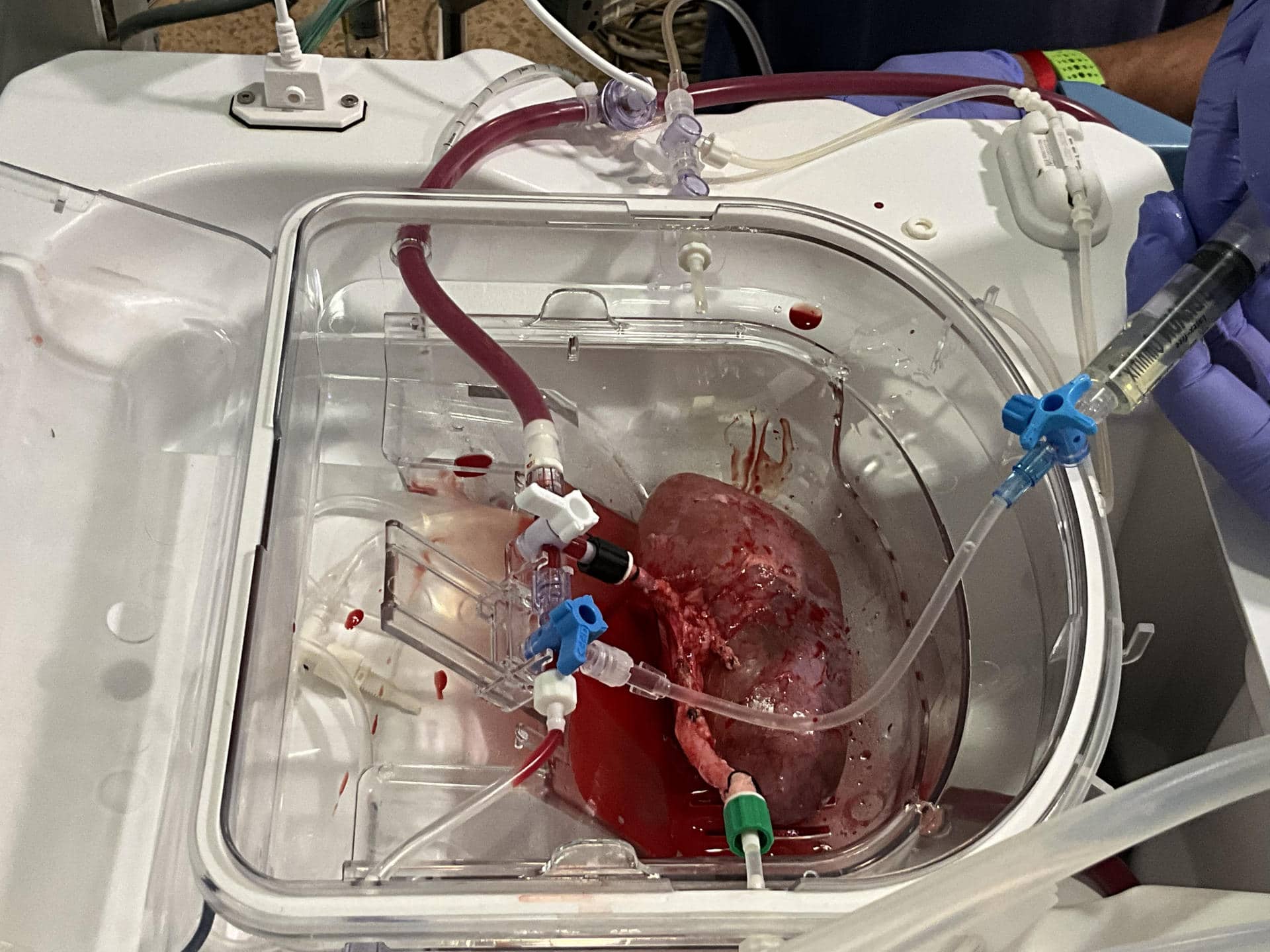 En la imagen, un riñón porcino conectado a la máquina de 'perfusión normotérmica', un dispositivo que sirve para preservar el riñón vivo y oxigenado de manera ex vivo (fuera del cuerpo). La imagen muestra el momento de la infusión de los organoides renales humanos en el riñón porcino. Fotografía cedida por el Instituto de Bioingeniería de Cataluña (IBEC)