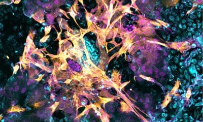 Imagen microscópica de un embrión humano de 14 días que se ha implantado en el nuevo modelo endometrial. Las células de color azul brillante en el centro de la imagen son células epiblasto no especializadas que, más adelante en el desarrollo, formarán todos los tejidos del cuerpo. Las células de color naranja son células trofoblasto que más adelante formarán la placenta. Las células azules que rodean al embrión son células endometriales que favorecen la implantación y el crecimiento del embrión. Crédito Matteo Molè, del Instituto Babraham.