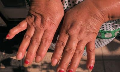 Una mujer muestra su manos con artritis en Ciudad de México (México). Imagen de archivo. EFE/Alex Cruzááá