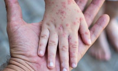 Confirmados 15 casos de sarampión en NC