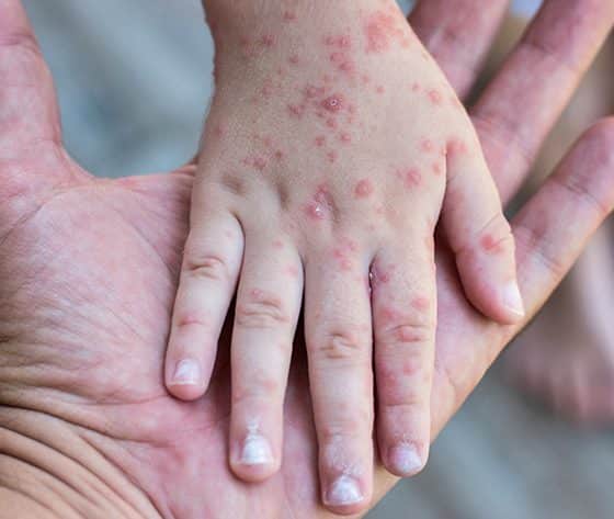 Confirmados 15 casos de sarampión en NC