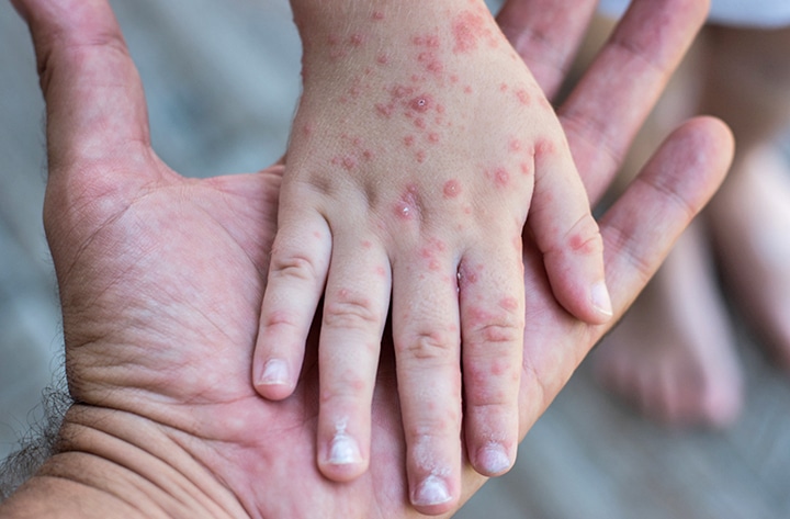 Confirmados 15 casos de sarampión en NC