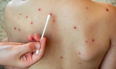 Aumentan a siete los casos de sarampión