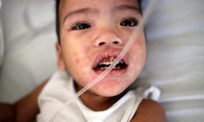 Imagen de archivo de un niño enfermo de sarampión. EFE/ Francis R. Malasig