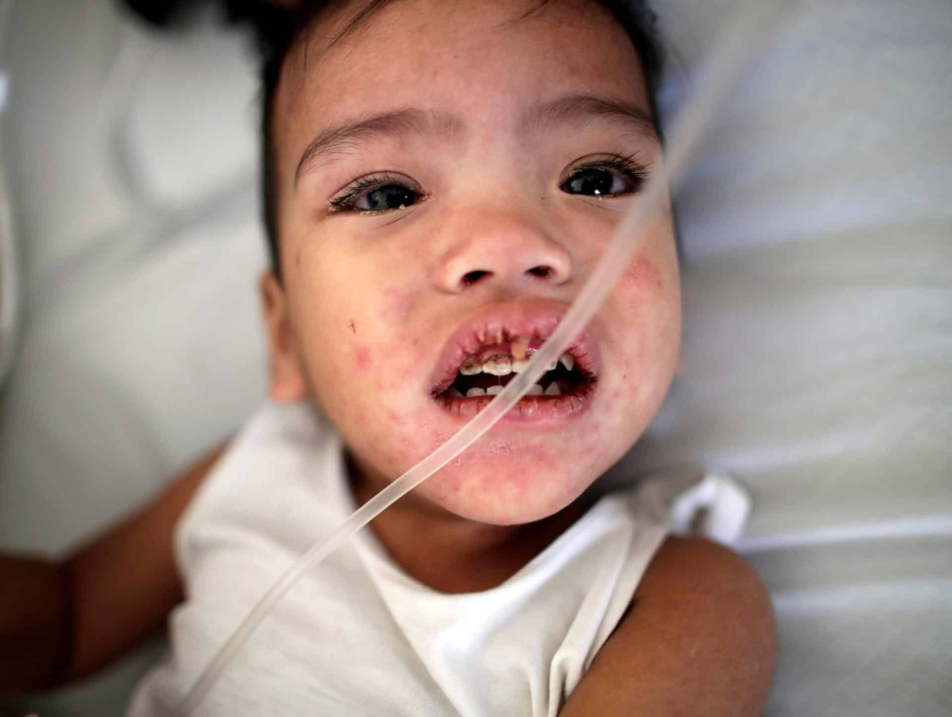 Imagen de archivo de un niño enfermo de sarampión. EFE/ Francis R. Malasig