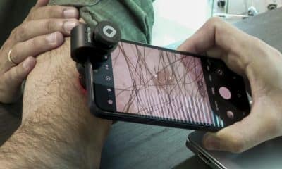 El telediagnóstico aplicado a la dermatología se erige como una opción eficaz y rápida para una detección temprana del melanoma, un cáncer de piel que se prevé que será diagnosticado con mayor fecuencia. Imagen de archivo. EFE/David Arjona