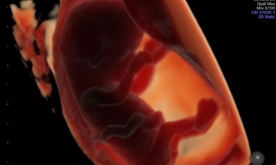 Esta imagen muestra un embrión de unas 11 semanas de gestación, obtenida mediante una ecografía transvaginal en 3D. Fotografía facilitada por el Grupo de estudio Generation R