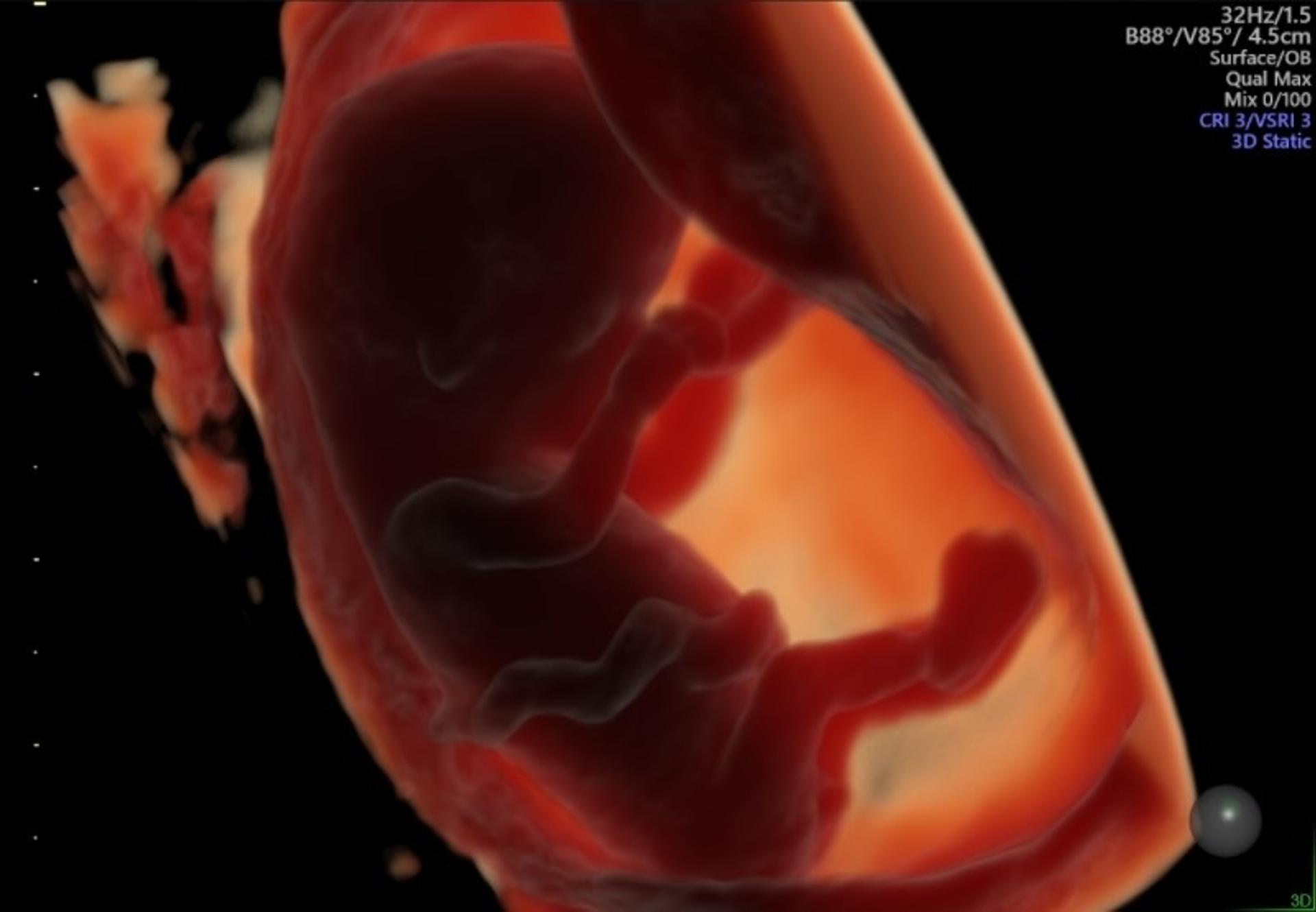 Esta imagen muestra un embrión de unas 11 semanas de gestación, obtenida mediante una ecografía transvaginal en 3D. Fotografía facilitada por el Grupo de estudio Generation R