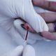 Una persona se realiza una prueba de Hepatitis en Ciudad de México (México). Fotografía de archivo. EFE/Sáshenka Gutiérrez